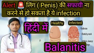 टोपी में संक्रमण  BALANITIS  खुजली दर्द जलन  balanitis treatment home remedies in hindi [upl. by Pirali]