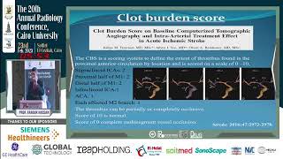 Embolus imaging in hyperacute stroke how it impacts our management plan [upl. by Sel10]