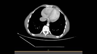 scanner abdomino pelvienne Contracture abdominale diffuse  suspicion de péritonite [upl. by Rehc223]