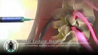 Lumbar Epidural Steroid Injection [upl. by Braden]