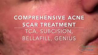 Comprehensive Acne Scar Treatment  Subcision Bellafill Genius [upl. by Hobie]