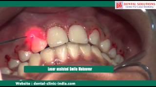 Laser Cosmetic Surgery Bangalore  Smile Makeover Treatment India [upl. by Naivatco187]