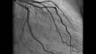 Coronary Angiography  NEJM [upl. by Hey531]