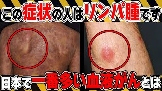 【日本で一番多い血液がん】絶対に見逃さないで！悪性リンパ腫の初期の危険サインとは？予防法についても医師が徹底解説！【医師監修】【悪性リンパ腫は】 [upl. by Estas]