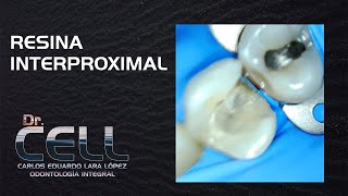 Resina Interproximal profunda [upl. by Thagard]