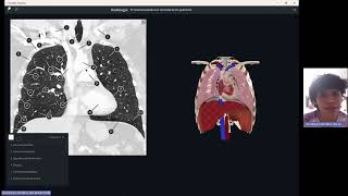 Tomografía de tóraxRadiant [upl. by Nashner975]