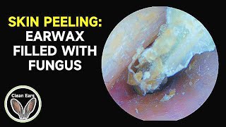 Skin Peeling Cerumen Filled With Fungus  Pay Attention To Ear Health [upl. by Inahpit961]