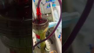 Plasmapheresis  YouTube viralshorts video [upl. by Ellennoj]