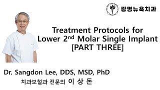 Treatment Protocols for Lower 2nd Molar Single Implant PART 3 [upl. by Nadruoj]