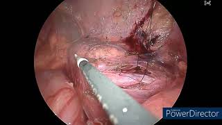 Laparoscopic ureteroureterostomy for mid ureteric obstruction [upl. by Araccot]