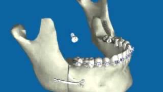 Retroceso de Mandíbula por Prognatismo Mandibular [upl. by Sue]