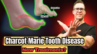 Charcot Marie Tooth Disease  Symptoms amp NEW Treatments 2024 [upl. by Kyrstin31]