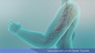 Vascularized Lymph Node Transfer What It Is amp How It Works [upl. by Shanda925]