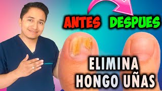 TRATAMIENTO para HONGOS en UÑAS de las MANOS y los PIES [upl. by Broder]