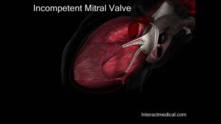 Mitral Valve normal and incompetent [upl. by Inalaek]