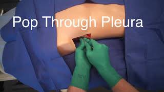 Chest Tube Placement POV Video [upl. by Alahcim]