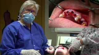 Physics Forceps Immediate Implant Placement Grafting tooth extraction overdenture [upl. by Myna]