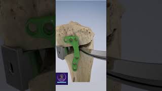 Osteotomy for Osteoarthritis shorts [upl. by Arlon]