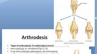 Orthopedics 102 Arthrodesis fusion of joint Triple arthrodesis for Polio CTEV GCT Osteoclastoma [upl. by Warenne]