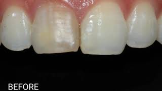 Enhance your smile with Ceramage Veneers [upl. by Anastas]