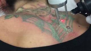 Green tattoo removal using Quanta Q Plus C laser [upl. by Yenetruoc]