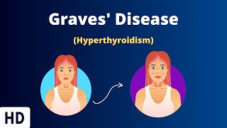 Graves Disease Everything You Need To Know [upl. by Jt898]