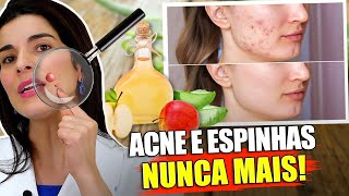 Diga ADEUS à ACNE e Espinhas Inflamadas com Esta Receita Poderosa [upl. by Ker24]