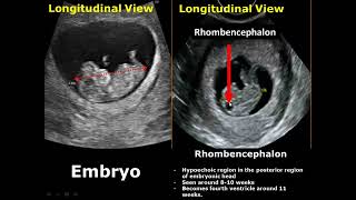 First Trimester amp Ectopic Pregnancy Ultrasound Image Appearances [upl. by Nabru]