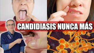 CURA DEFINITIVA para el hongo CANDIDA ¡sorprendente y natural [upl. by Nilats]