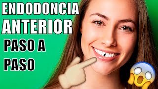 ENDODONCIA EN EL DIENTE DELANTERO ME ROMPÍ UN DIENTE COMO ES UNA ENDODONCIA COMO MTAR EL NERVIO [upl. by Sanbo]