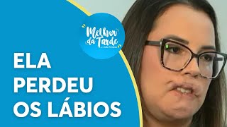 Mulher perde os lábios após procedimento estético com PMMA  Melhor da Tarde [upl. by Philender]