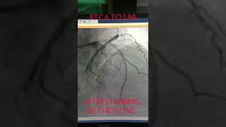 AngioplastyPTCA to LAD  coronary Stenting  Single Vessel disease alliedhealthsciences [upl. by Ulita795]