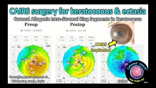 CataractCoach™ 2317 CAIRS surgery for keratoconus and corneal ectasia [upl. by Joktan]