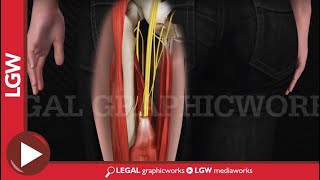 Hamstring Repair Surgery 3D animation [upl. by Hourihan437]