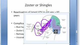 Microbiology 457 b Zoster Shingles VZV Varicella Zoster Virus ophthalmicus ramsay hunt acyclovir [upl. by Ahsatak]