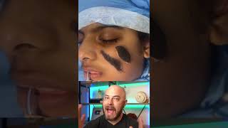 Derm explains hairy nevus treatment dermreacts doctorreacts nevus [upl. by Lednic]