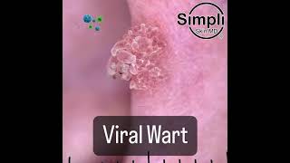 Viral Wart [upl. by Anaira]