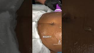 Body Sculpting Tip Lipo Cavitation Technique [upl. by Hsu]