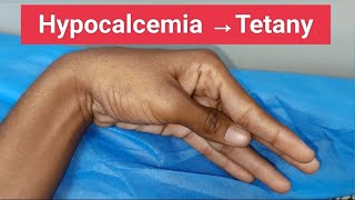 Hypocalcemia and Tetany [upl. by Marianna]