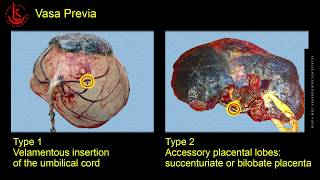 Vasa Previa Ultrasound Diagnosis [upl. by Spatola]