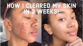 How I Got Rid of My Acne in 2 Weeks BEFORE AND AFTER PHOTOS  Treating Acne with Healing Clay Mask [upl. by Almallah]