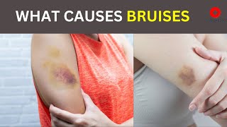 Bruises  Why does it happens  Symptoms Causes and treatment [upl. by Selda]