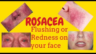 Rosacea or Potato nose or Rhinophyma or Redness of the face Phymatous rosacea Telangiectasia [upl. by Nawat]