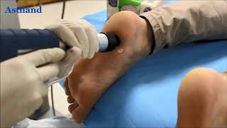 shockwave therapy machine operation video [upl. by Nav]