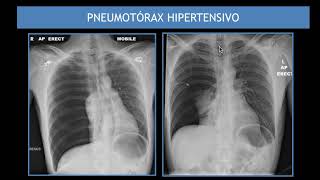 Síndromes Parietal Pleural e Mediastinal PARTE 2 [upl. by Isaiah]