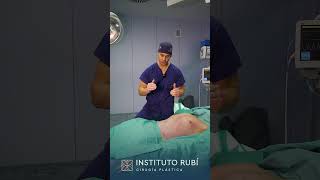 Cirugía plástica de lipoescultura con marcación abdominal [upl. by Haronid]