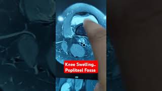 Knee Swelling Popliteal Fossa Dr Sai Chandra [upl. by Salbu]