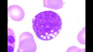 Vacuolated and basophilic blasts of Burkitt Lymphoma [upl. by Coulson]