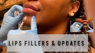 Black Woman  Lip FillersProdecure ReFill 3 Months Post OP Update [upl. by Ailyn]