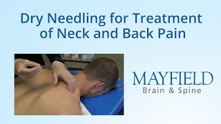 Dry Needling for Treatment of Neck and Back Pain [upl. by Annette244]